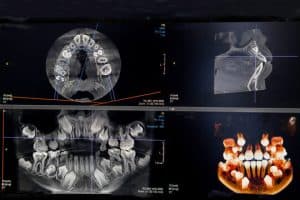 OPG and CBCT in Dental Imaging: A Complete Guide for Patients