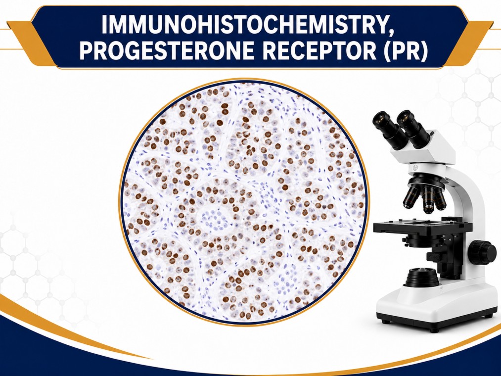 IHC Progesterone Receptor (PR) immunohistochemistry test showing hormone receptor staining in breast cancer tissue under microscope