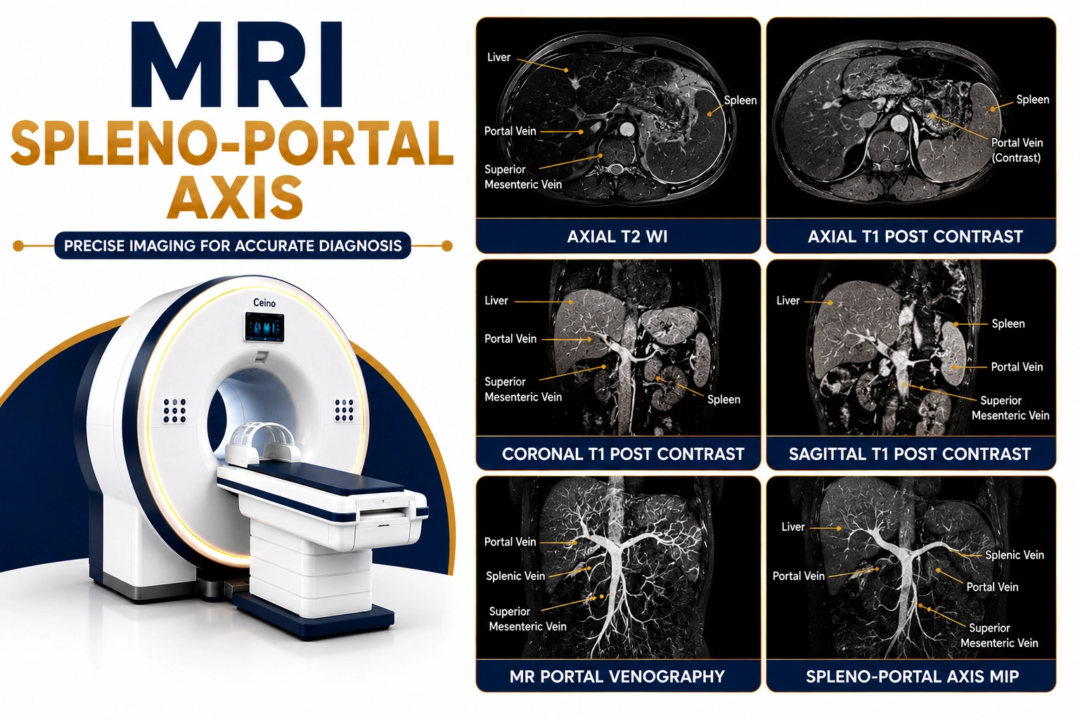 MRI Spleno Portal Axis scan for evaluation of portal vein, splenic vein, portal hypertension, thrombosis, liver disease, and vascular abnormalities at Focus Diagnostics