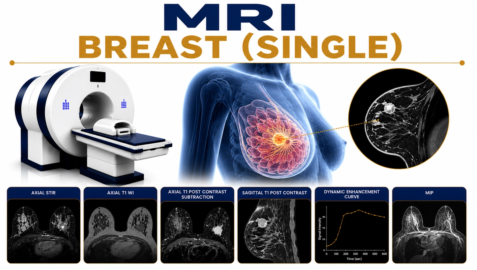 MRI Breast Single Breast scan at Focus Diagnostics showing detailed imaging of breast tissue, ducts, implants, and potential breast abnormalities