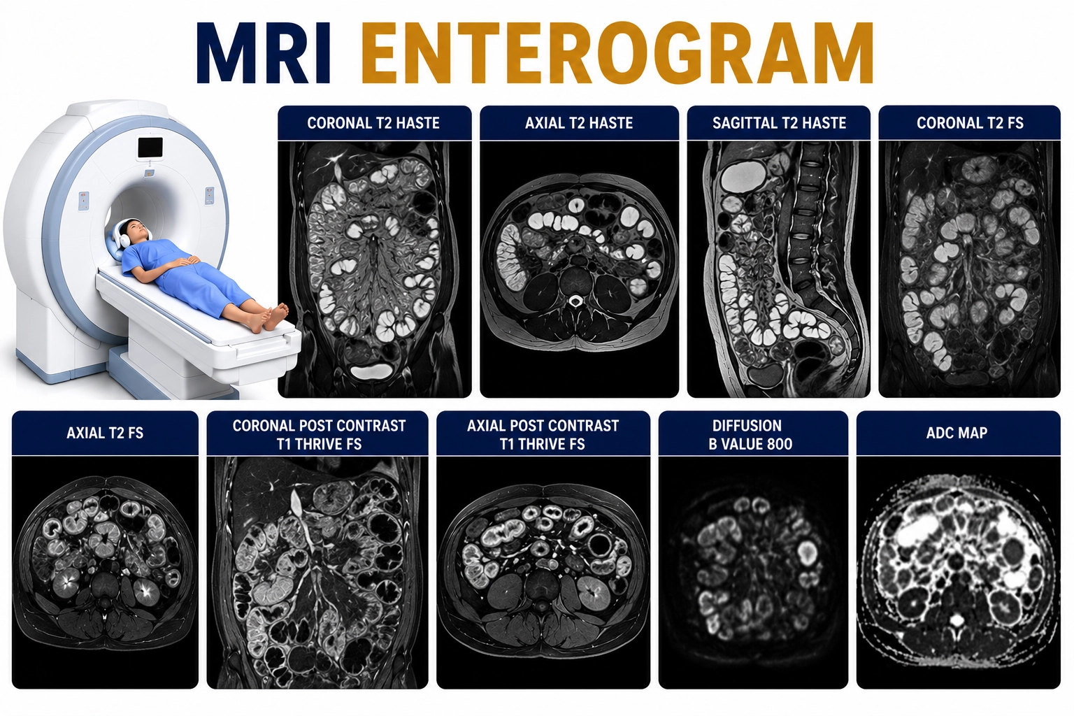 MRI Enterogram scan at Focus Diagnostics for detailed small intestine and gastrointestinal tract imaging