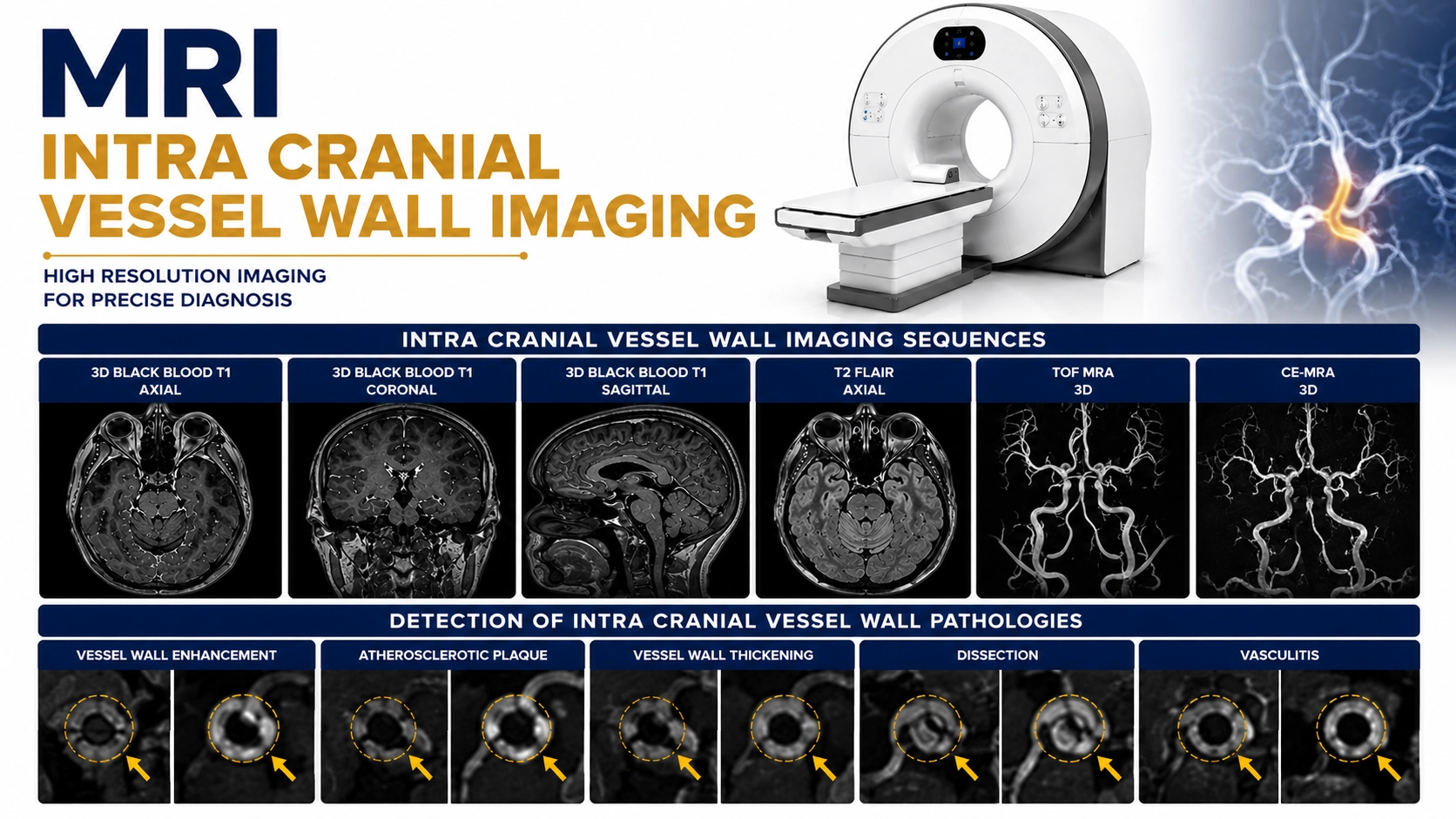 MRI Intra Cranial Vessel Wall Imaging scan for detailed evaluation of intracranial blood vessel walls at Focus Diagnostics