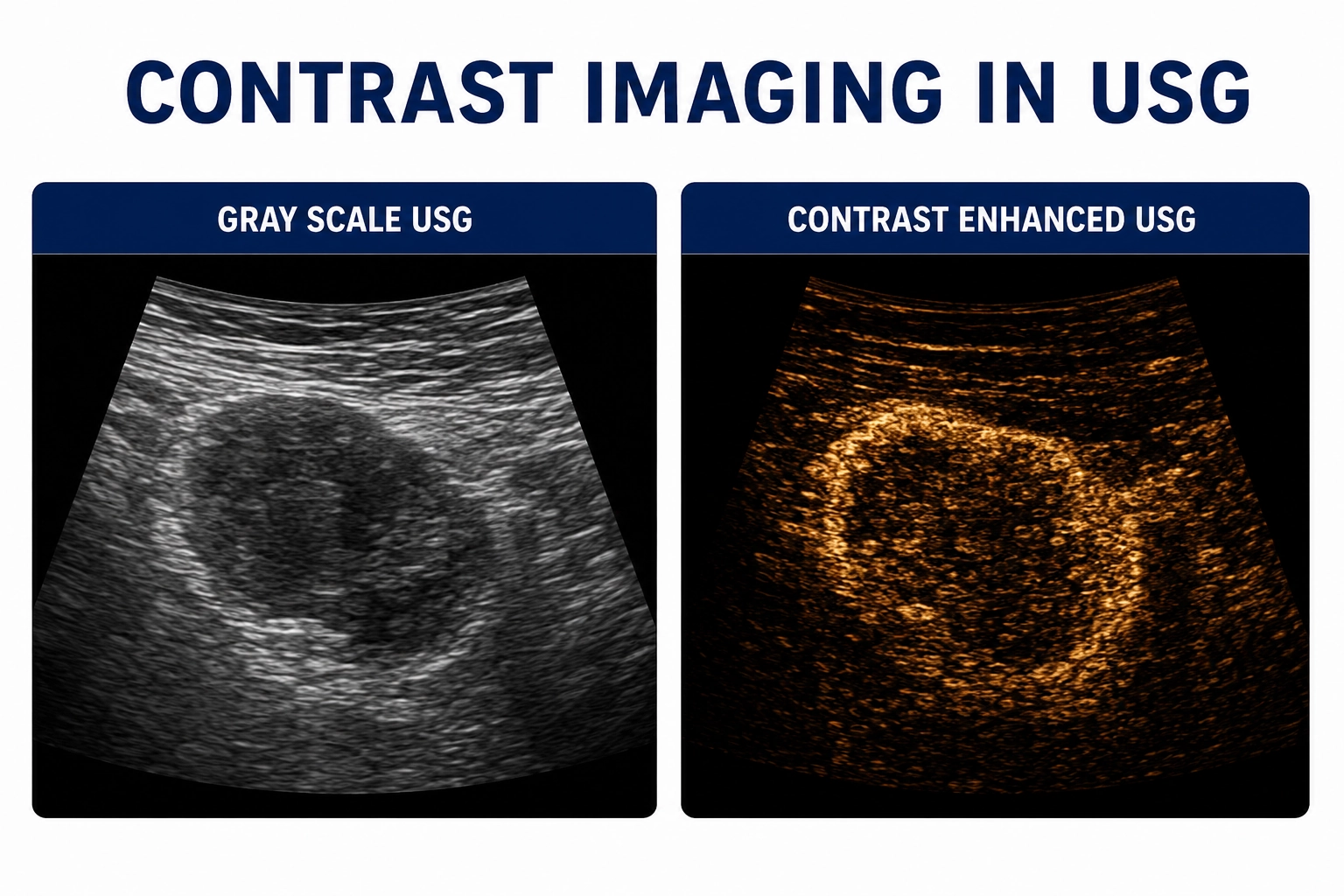 Contrast Imaging in USG for advanced evaluation of liver lesions, tumors, vascular abnormalities, organ perfusion, and diagnostic ultrasound assessment at Focus Diagnostics
