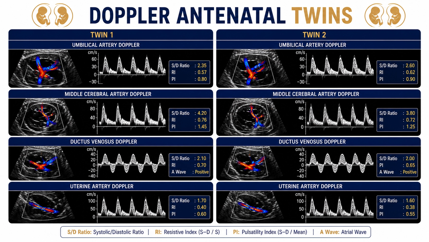 Doppler Antenatal Twins ultrasound for monitoring fetal blood flow, placental circulation, twin pregnancy health, and fetal well-being at Focus Diagnostics