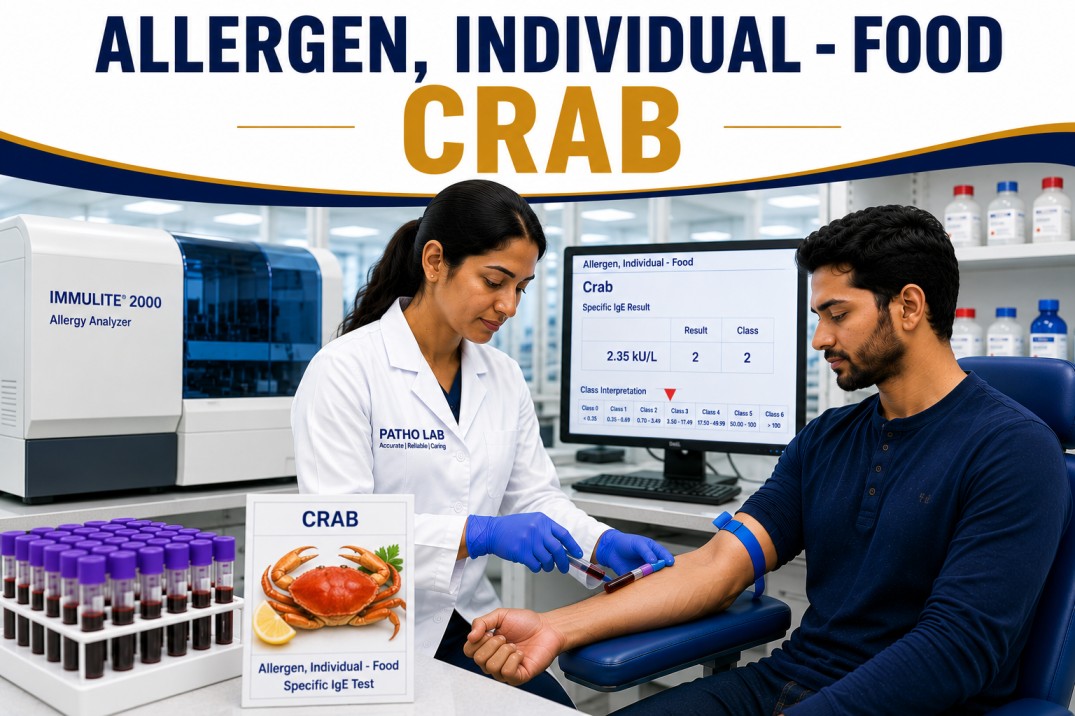 Crab allergy test showing specific IgE antibody analysis for crab sensitization, shellfish allergy diagnosis, and seafood allergy evaluation