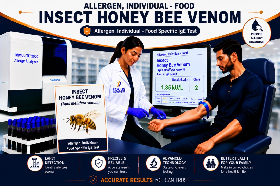 Honey bee venom allergy test showing specific IgE antibody analysis for bee sting sensitization, venom allergy diagnosis, and anaphylaxis risk assessment