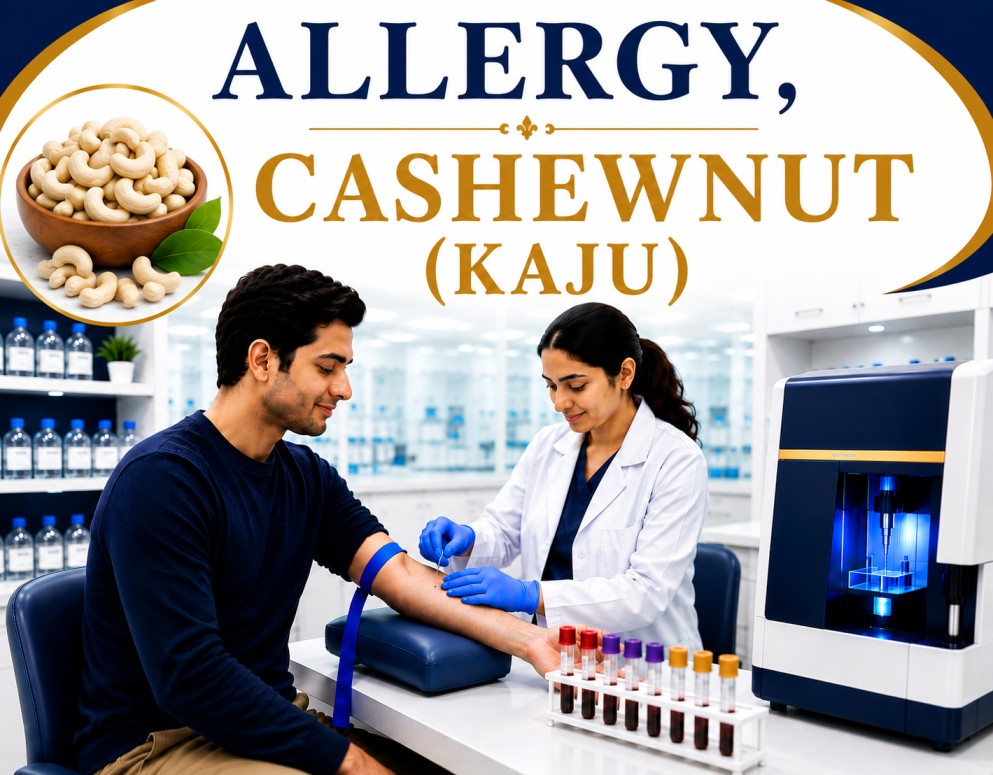 Cashewnut (Kaju) allergy blood test showing specific IgE antibody analysis for tree nut allergy, food hypersensitivity, and severe allergic reaction evaluation