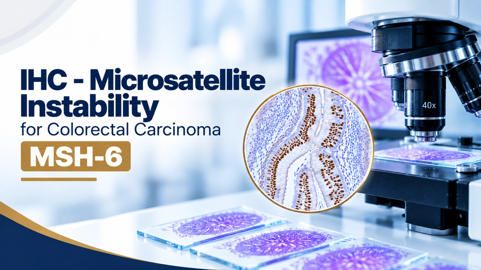 MSH6 immunohistochemistry staining in colorectal carcinoma tissue for microsatellite instability and Lynch syndrome screening